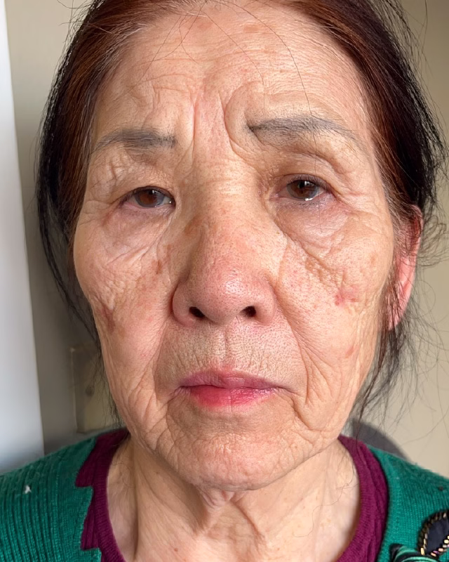 photo of elderly chinese woman before 20 days of red light therapy treatment